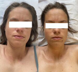 Drainage Visage Avant/après